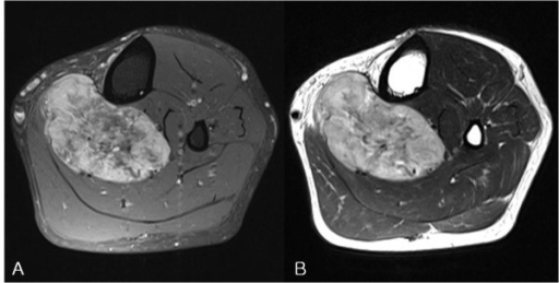 MRI images of an alveolar soft part (A) An axi