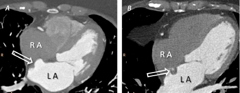 Panel A. Axial View With Atrial Septal Aneurysm Highlig 