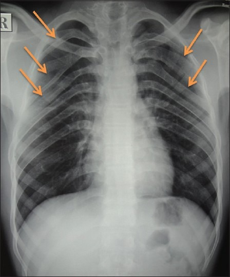 Chest radiograph showing bifid ribs | Open-i