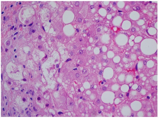 Liver Histology Of A Patient With Mtx Induced Hepatotox 