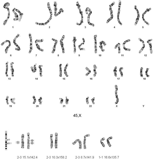 GTW-banded karyotypes of monosomy X and Xq duplication | Open-i