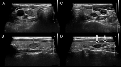 Sonography showed the right parathyroid gland within th | Open-i