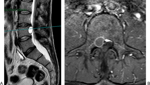 Sagittal T2-weighted (A) and axial T1-weighted postgado | Open-i