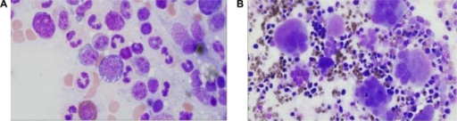 Refractory cytopenia with unilineage dysplasia (RCUD). | Open-i