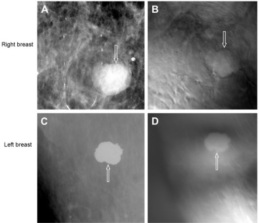 Images from case 1. (A) Prone cranial-caudal mammogram