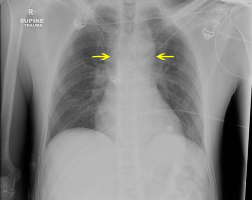 Chest Radiograph Demonstrating A Widened Upper Mediasti Open i chest-radiograph-demonstrating-a-widened-upper-mediasti-open-i