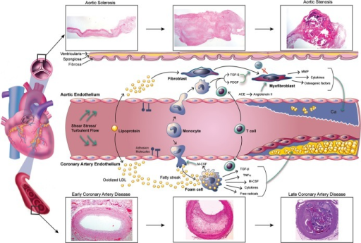 Pathophysiology of aortic sclerosis, aortic stenosis, a | Open-i