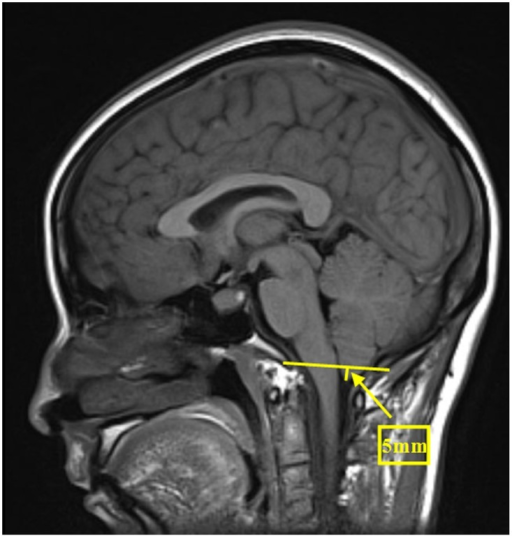 Typical MRI manifestation of brain sagging.Midsagittal | Open-i