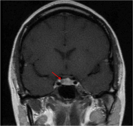 Pituitary Magnetic Resonance Imaging Mri Coronal Imag Open I 