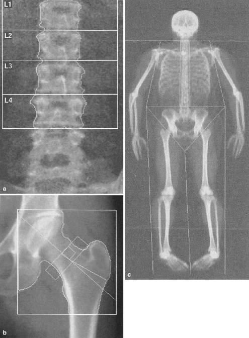 Dxa Images A Ap Image Of The Lumbar Spine Shows Region Open I