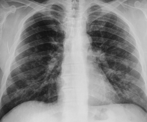 Chest radiograph showing ill-defined nodular opacities | Open-i