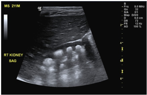 sagittal-ultrasound-of-the-right-kidney-revealing-prese-open-i