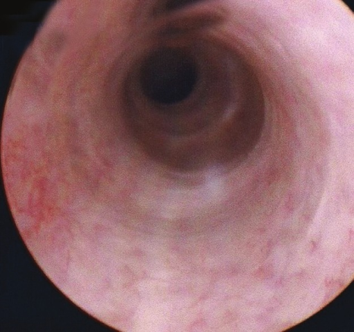 Postoperative Photograph Of Pendulous Urethra Op