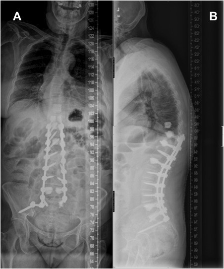 Postoperative p-a and lateral x-rays showing a posterol | Open-i