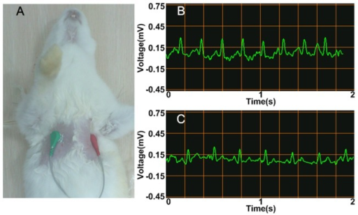 how-to-read-ecg-test-results