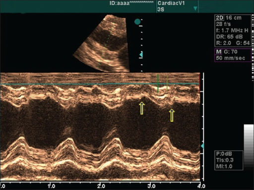 septal-motion-abnormality-septal-bounce-open-i