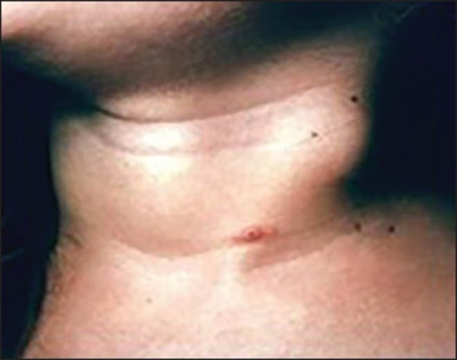 Bilateral neck swelling | Open-i