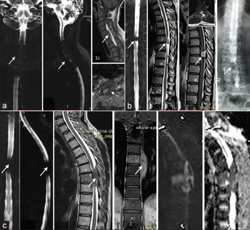 Coronal and sagittal myelography (a-i, a-ii) shows simu | Open-i