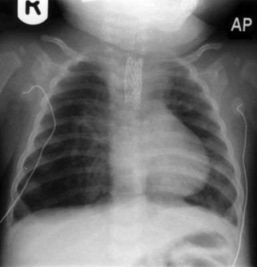 Chest x-ray prior to last discharge with clear distal l | Open-i