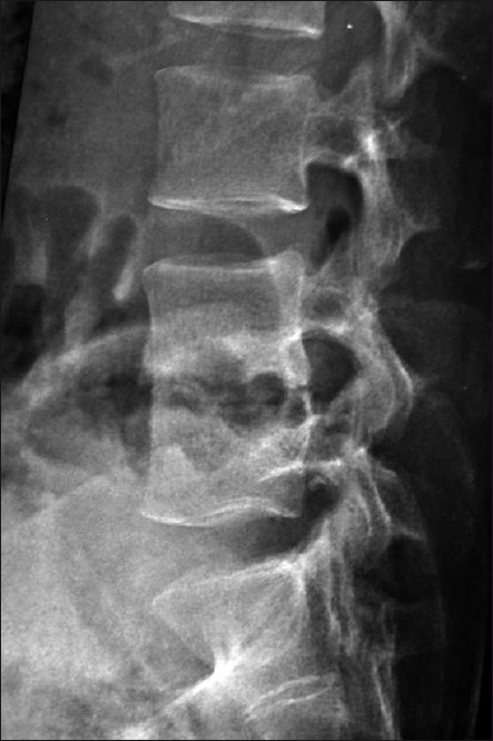 X-ray of lumbar spine (Lateral view) depicting lytic le | Open-i