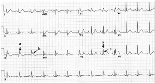 Initial ECG showing QRS fragmentation (a, fragmentation | Open-i