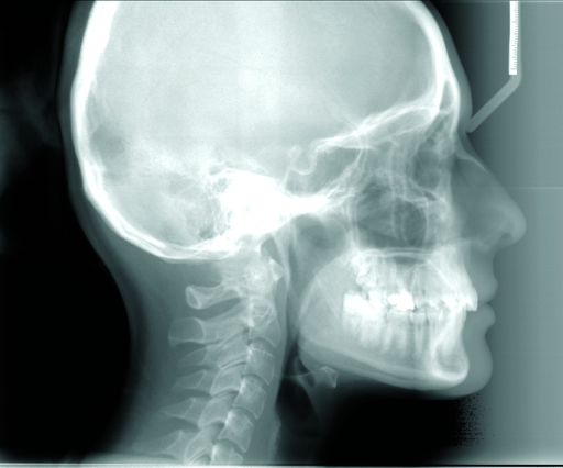 Initial lateral cephalometric radiograph. | Open-i