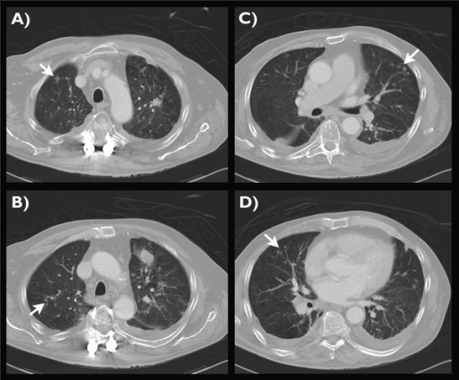 Follow-up contrast enhanced CT scan of the chest. The a | Open-i