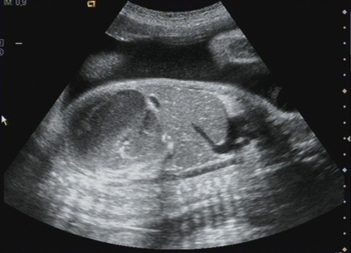 Ultrasound image: 32.3 weeks of gestation. Longitudinal | Open-i