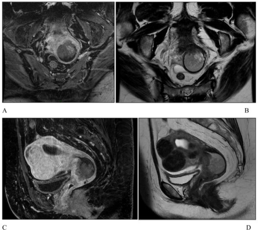 Mri Findings Mid Sagittal Pelvic A T1 Weighted Post Open I