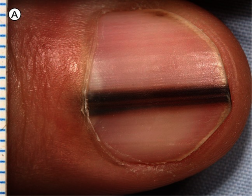 A Close Up Image Of Longitudinal Melanonychia On The Open I A Close Up Image Of Longitudinal Melanonychia On The Right Thumbnail