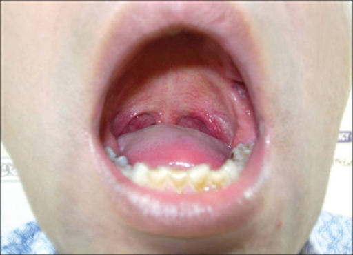 is a yellow soft palate normal