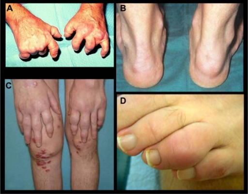 Psoriatic Arthritis.Notes: Patients With Psoriatic Arth | Open-i