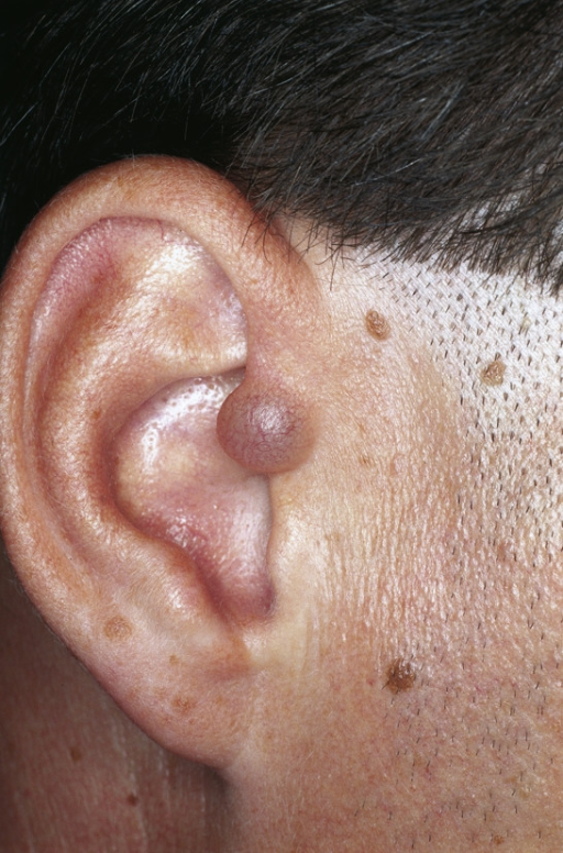 auricular-appandage-dome-shaped-flesh-colored-nodule-open-i