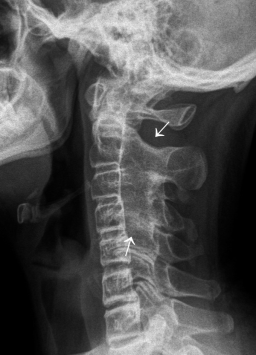 ankylosing spondylitis cervical spine x ray