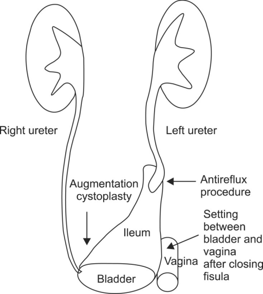 Case 1: A 20-cm ileal segment was isolated for bladder | Open-i