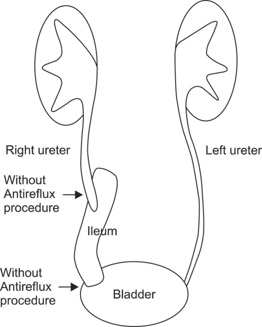 Case 4: The mid and lower ureter were replaced by an is | Open-i