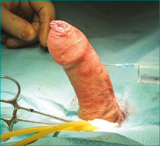 Curved Penis Surgery 72