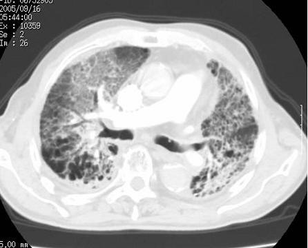 CT images of radiation pneumonitis after SBRT (Pt. No. | Open-i