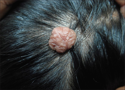 A Single Pedunculated Tumor Like Mass On Vertex Of Scal Open I