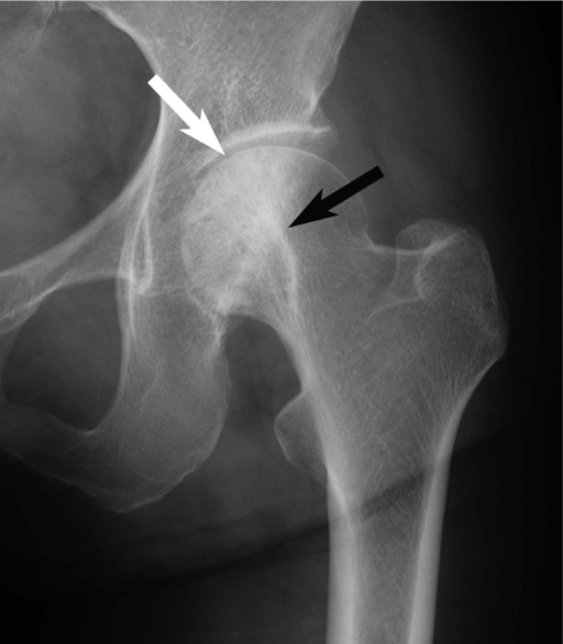 Radiograph of the left hip joint at 12 months after the | Open-i