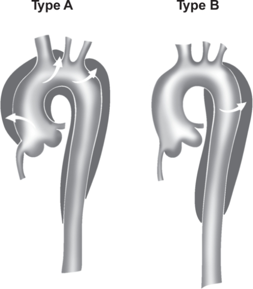 Stanford Classification Of Aortic Dissection Stanford Open I