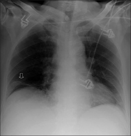 Plate atelectasis/discoid atelectasis (arrow) is common | Open-i