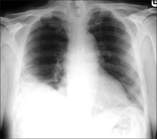 A relatively late sign of pulmonary infarction is a rou | Open-i