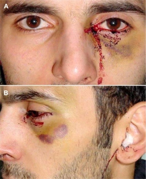 A) Bloody tears in the left eye and hematomas on left | Open-i