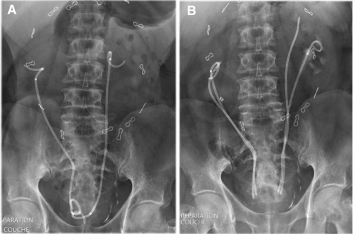 Appearance Of Ureteral Stents On X-ray. (A) Double-pigt | Open-i