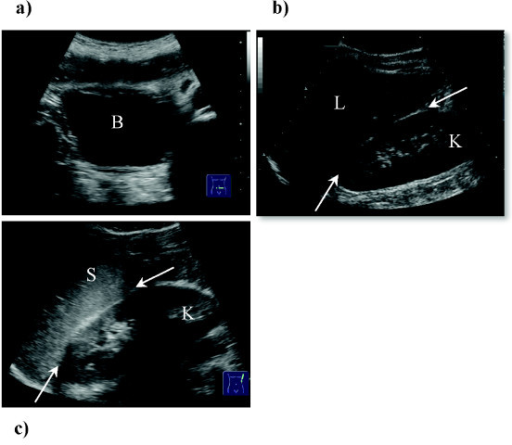 a-c. a) Rectouterine pouch (females) or rectovesical ex | Open-i