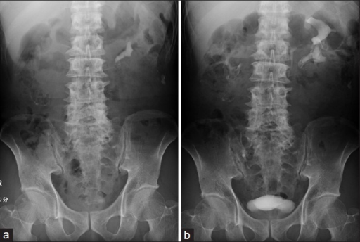 a-kub-radiography-reveals-a-lower-pole-renal-calculus-open-i