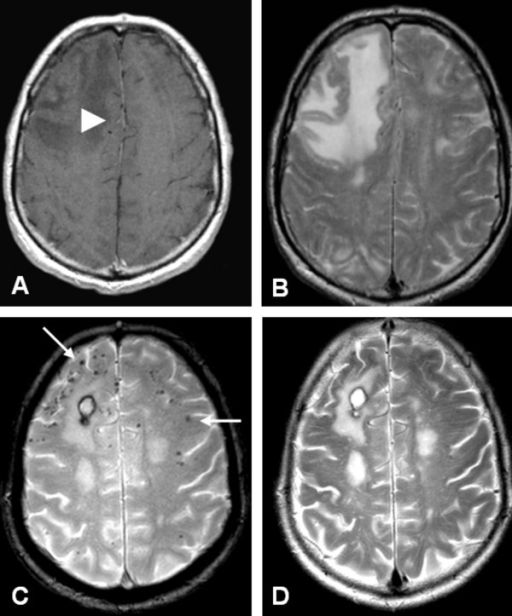 Axial MRI at presentation (A, B) and 3 months after tre | Open-i