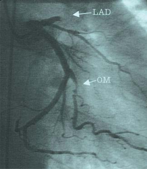 Left Coronary Artery Angiograms Showing Total Occlusion 