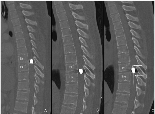 Noncontrast CT reconstructed sagittal images of the tho | Open-i